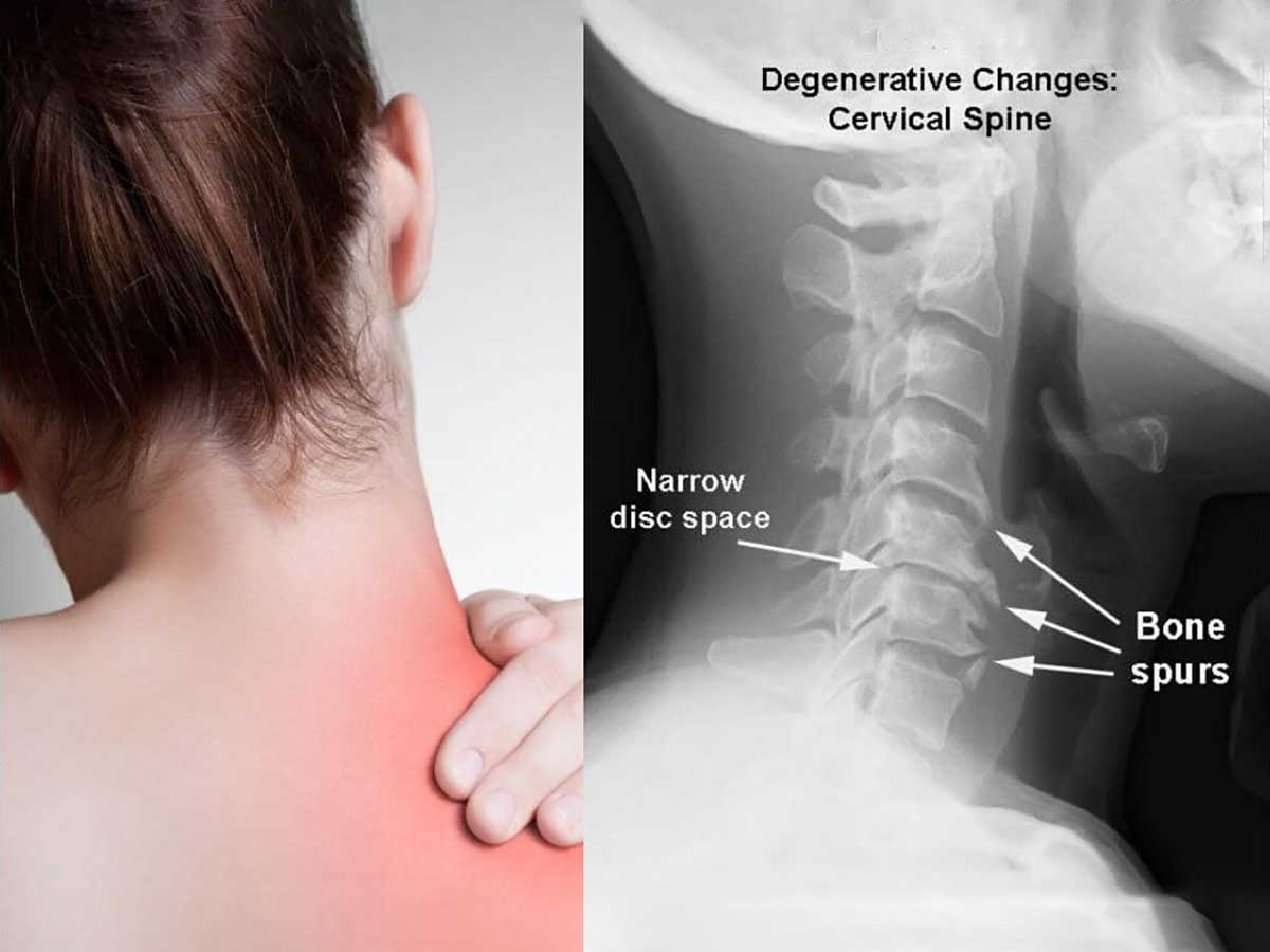 Cervical decompression treatment applied to a patient's neck